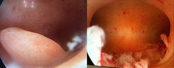 imagine polipi endometriali din timpul interventiei chirurgicale